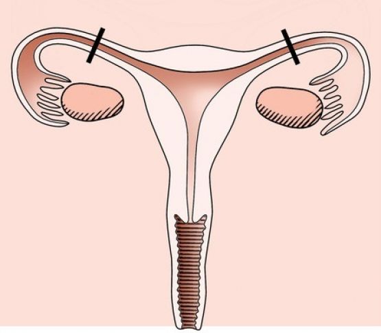 Weibliche Sterilisation - Aufwendigere OP